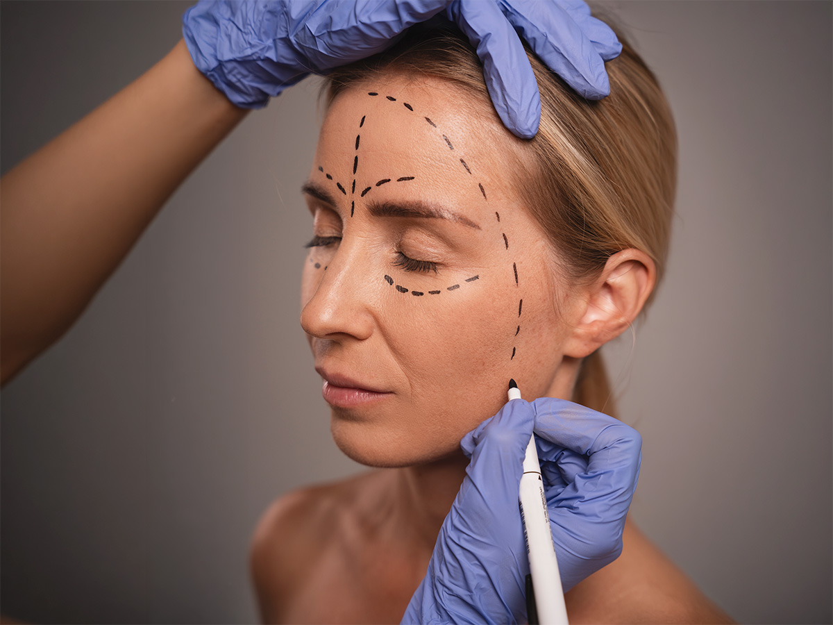 Unas manos con guantes marcan con rotulador líneas discontinuas en el rostro de una persona con los ojos cerrados.